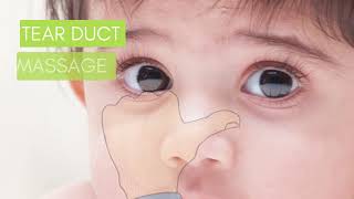 How to Massage Blocked Tear Duct in Children [upl. by Ume99]