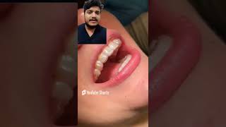 Fixed retainers after orthodontic treatment trending hospital dentalschoollife viralvideo [upl. by Alissa]