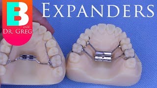 BRACES EXPLAINED Palatal Expanders [upl. by Aibun762]