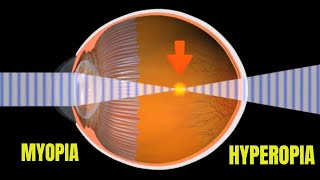 Myopia and Hyperopia [upl. by Brittne]