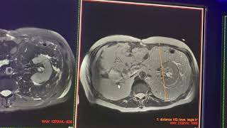 Mielolipoma vs lipoma perirrenal gigante vs liposarcoma retroperitoneal [upl. by Eugaet]