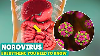 Norovirus Explained Causes Symptoms and How to Recover Fast [upl. by Gianna]