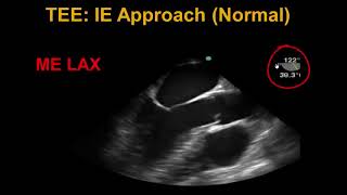 Transesophageal Echocardiography Infective Endocarditis [upl. by Eilis417]