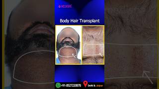 Hair Transplant by Body Hair BHT explained by Dr Suneet Soni at Medispa Hair Transplant India [upl. by Jacinto]