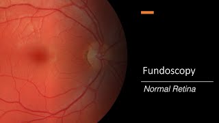 Healthy Retina Fundoscopy [upl. by Lais]