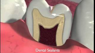 Dental Sealants and Fissurotomy [upl. by Casaleggio]