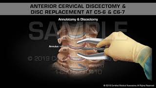 Anterior Cervical Discectomy amp Disc Replacement at C56 amp C67  Medical Animation [upl. by Akirdnas]