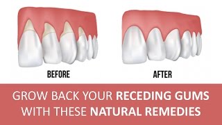 5 Effective Home Remedies for Gum Disease [upl. by Nosinned289]