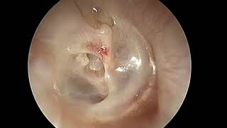 Endoscopic tympanoplasty with ossiculoplasty [upl. by Eatnuahs]