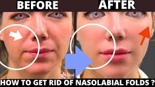 🛑 HOW TO GET RID OF NASOLABIAL FOLDS WITH FACE YOGA  LAUGH LINES JOWLS SAGGY SKIN FOREHEAD LINES [upl. by Imyaj]