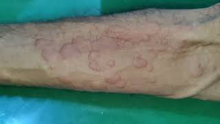 Urticarial Rash due to Drug Reaction [upl. by Julieta]