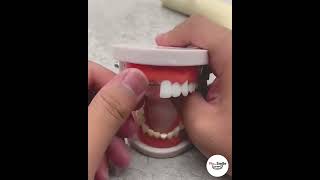 Moldable Teeth Filler  Result in Minutes  FixmySmile [upl. by Sucramraj540]