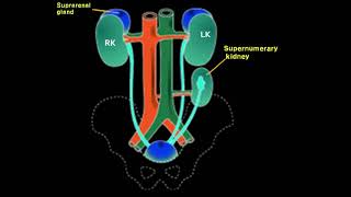 Supernumerary kidney 과다 신장 [upl. by Lyons8]