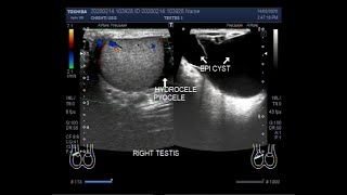 Ultrasound Video showing Two large Epididymal cysts with bilateral Hydrocele and pyocele [upl. by Esyle679]