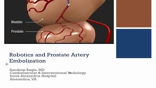 Advantages of Prostate Artery Embolization with the Magellan Robotic System [upl. by Yarased144]