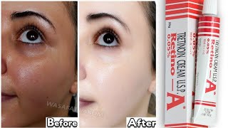 Tretinoin mistakes that ruined my skin 😫 tretinoin skincare beauty Not Really [upl. by Mirilla]