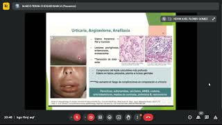 Dermatología Urticaria angioedema sd Stevens Johnson Necrósis epidermoide tóxica TUMORES2106 [upl. by Johannessen]