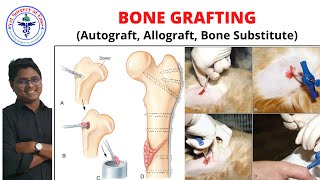 BONE GRAFTING  Lecture 05  Orthopedics [upl. by Surovy458]