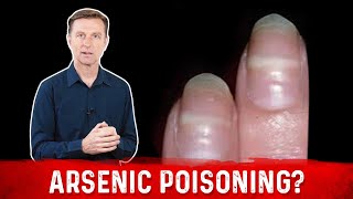 Identify Arsenic Poisoning Through Your Nails [upl. by Caritta]