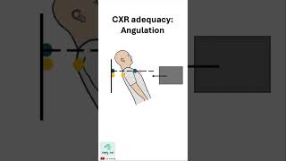 Chest xray adequacy ANGULATION [upl. by Ecylahs]