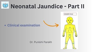 Neonatal Jaundice Part II [upl. by Horgan]