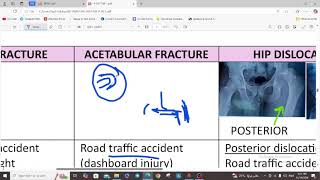 LOWER LIMB FRACTURES  ORTHOPEDICS  5TH YEAR [upl. by Brinson79]