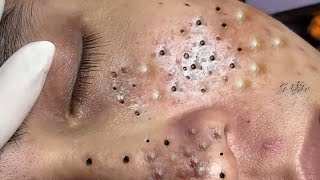 Big Cystic Acne Blackheads Extraction Blackheads amp Milia Whiteheads Removal Pimple Popping  2498 [upl. by Hpotsirhc]