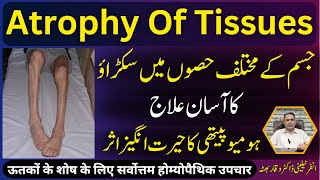 Atrophy Of Tissues جسم مین سکڑاؤ शारीरिक संकुचन Homeopathic Treatment In Urdu  Hindi [upl. by Newob304]