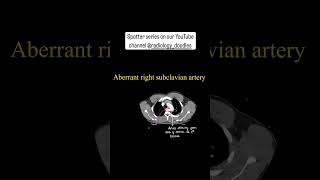 Aberrant right subclavian artery radiology anatomy xray mri ctscan chest hrct [upl. by Sotsirhc]