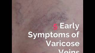 5 Early Symptoms of Varicose Veins [upl. by Lada]