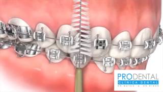 ¿Cómo lavarse correctamente los dientes con brackets [upl. by Anirdnajela]