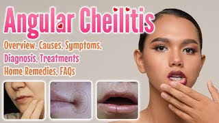 Angular cheilitis overview causes sign and symptoms diagnosis treatment home remedies and FAQs [upl. by Ynner]