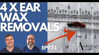 4 x EAR WAX REMOVALS INC BIG EAR WAX PLUG  EP923 [upl. by Nnyleahs]