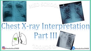 Chest Xray interpretation made easy III [upl. by Ackley]