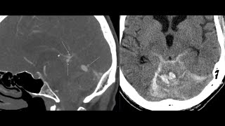 Multiple cerebral venous varices  venous aneurysms and intracranial hemorrhage  rare case [upl. by Werner]