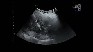 Ultrasound guided microwave ablation for uterine myoma [upl. by Elroy]