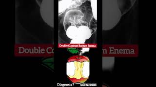 Diagnosis  Barium Enema  Practical Case  Radiology [upl. by Maxwell]