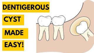 Dentigerous Cyst Clinical features Radiology Histology and Treatment [upl. by Charleton]