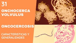 ONCHOCERCA 31  ONCOCERCOSIS  NEMATODOS [upl. by Leoy81]