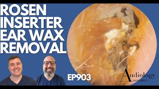 ROSEN INSERTER EAR WAX REMOVAL amp OTHERS  EP903 [upl. by Porett733]