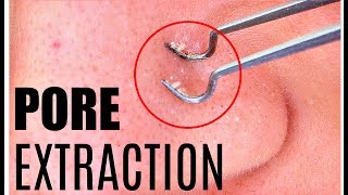 BLACKHEAD Removal  Extraction  How To POP a Pimple by Golani [upl. by Isdnil]