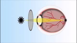 Presbyopia Explained Annimated Video [upl. by Trudy]