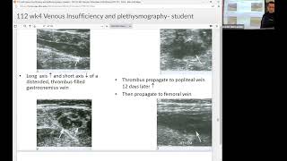 Venous Plethysmography [upl. by Suixela14]