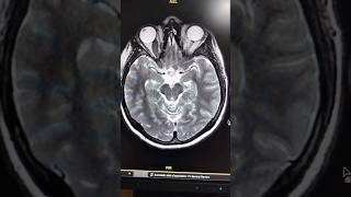 Optic Nerve Glioma [upl. by Jenni]