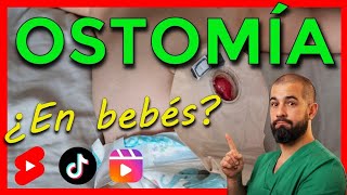 ¿Sabías que los bebés pueden tener ostomias [upl. by Broeker]