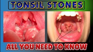 Tonsil Stones  Tonsil Stones Treatment  Tonsil Stone Removal  All You Need to Know [upl. by Jago]