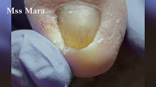 Mss Mara Ep44  Foot Care Clean the Skin and remove the corner of the nail Podología Integral [upl. by Thorne]