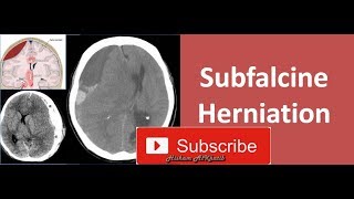 Subfalcine Herniation [upl. by Anola615]