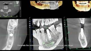 Meyer 3D Pro Mydent Viewer© yazılımı kullanım ve fonksiyonlar [upl. by Annairam]