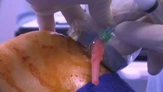 WATCH a Knee Joint Injection  LIVE [upl. by Annaer26]